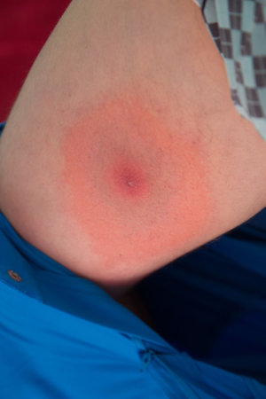 Rash as a symptom of Lyme disease on a leg of a male
